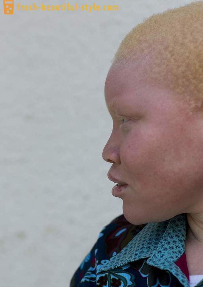 Tragická historie tanzanských albínů