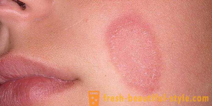 Šupinatá kůže na obličeji a rukou: Možné příčiny a charakteristiky péče
