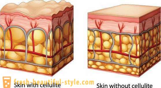 Jak si vybrat celulitidě: hodnocení hostů a radu kosmetičky
