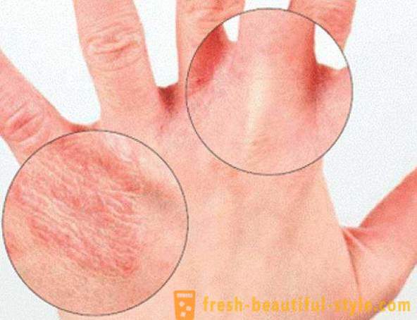 Suchá pokožka rukou: Způsobuje. Velmi suchá kůže, co mám dělat?