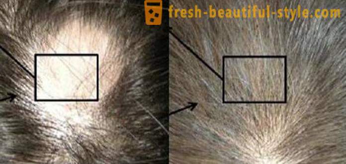 Mezoterapie na vlasy: Kosmetické nástroje a kontraindikace