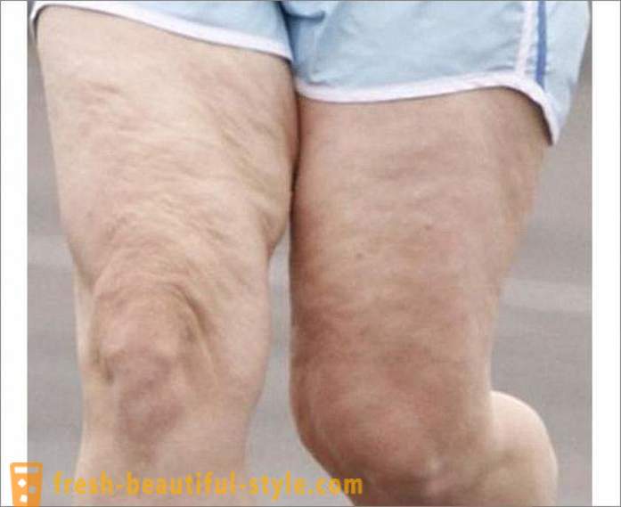 Jak se zbavit celulitidy na nohou? Cvičení pro nohy celulitidy